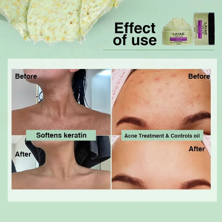 Ailke All Natural Aloe Vera Grease Control Pimples Facial Korean Body Wash Organic Body Scrub for Acne Skin